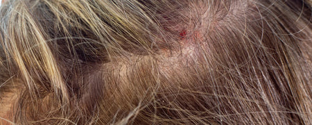 Scalp inflammation: Causes, natural treatments and prevention strategies