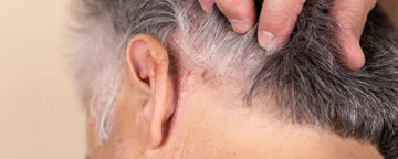 Psoriasis i hovedbunden