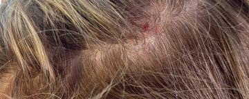 Scalp inflammation
