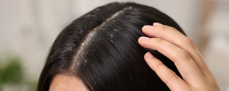 Tea tree oil for dandruff: How to get natural relief