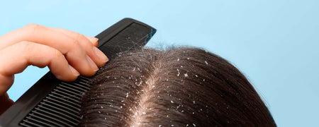 Dandruff: How to avoid it in the hair and scalp
